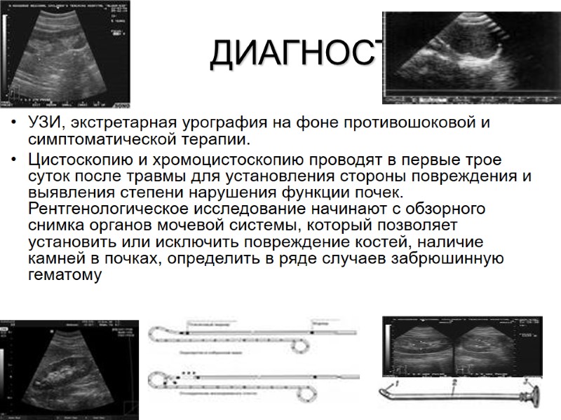 ДИАГНОСТИКА УЗИ, экстретарная урография на фоне противошоковой и симптоматической терапии. Цистоскопию и хромоцистоскопию проводят